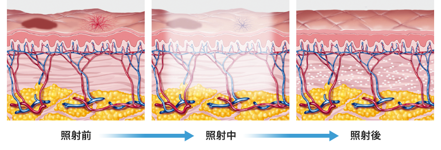 照射前→照射中→照射後